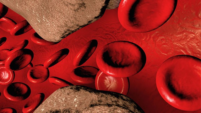 диагностирование атеросклероза