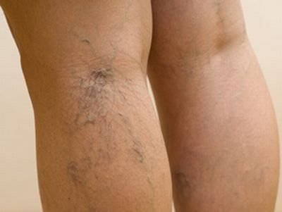 лечить варикоз вен