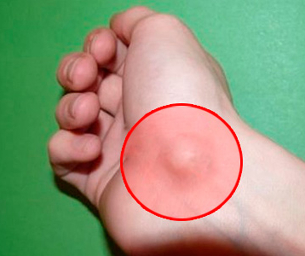 что такое гигрома