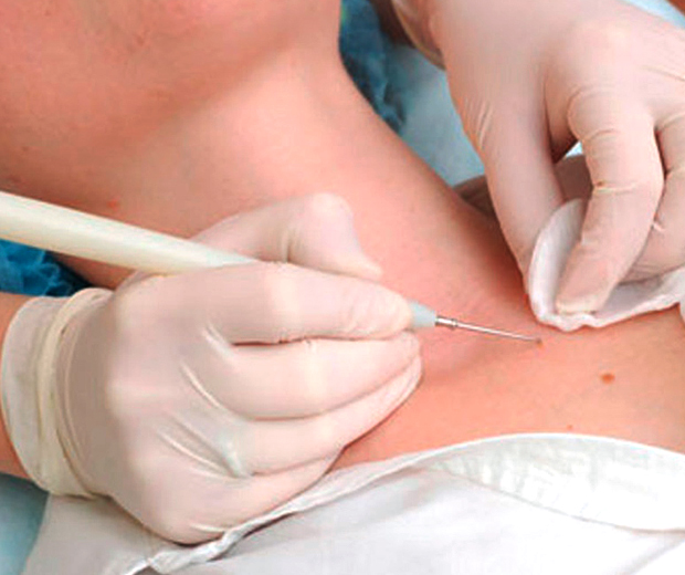 удаление опухолей в стационаре