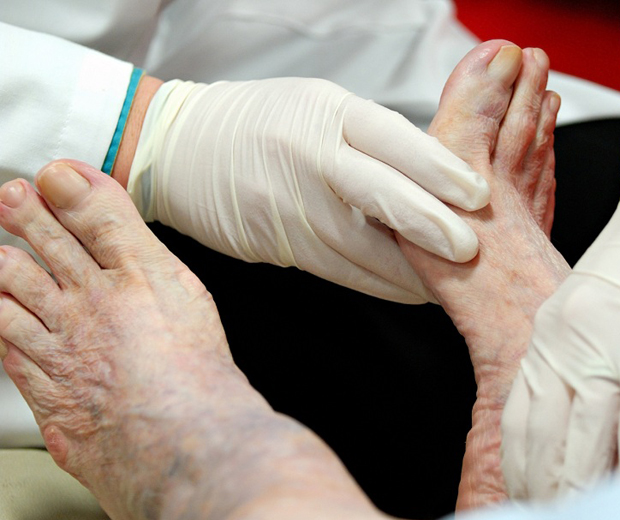 вылечить диабетическую стопу