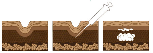 косметологическое устранение морщин