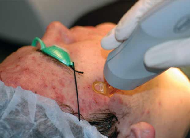 медицинское избавление от угревой сыпи