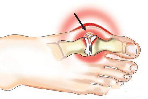 врач поставил диагноз - подагра