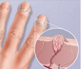 удаление бородавок в Москве 