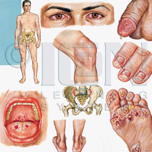 лечиться от хламидии симпотмы