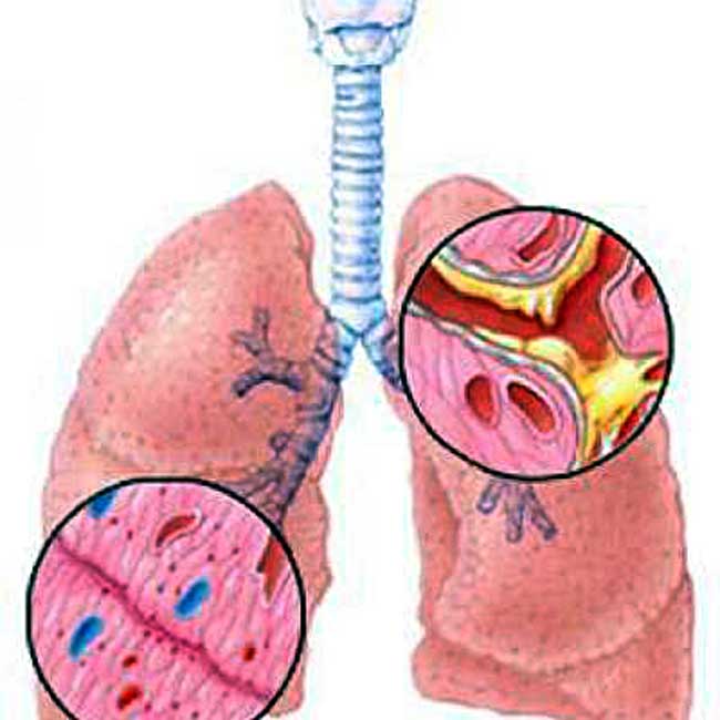 как лечить бронхит