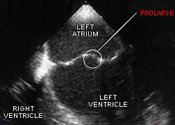 как диагностироваться на пролапс