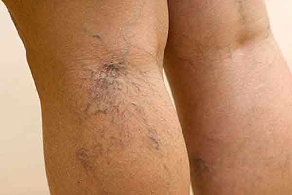 варикоз лечение