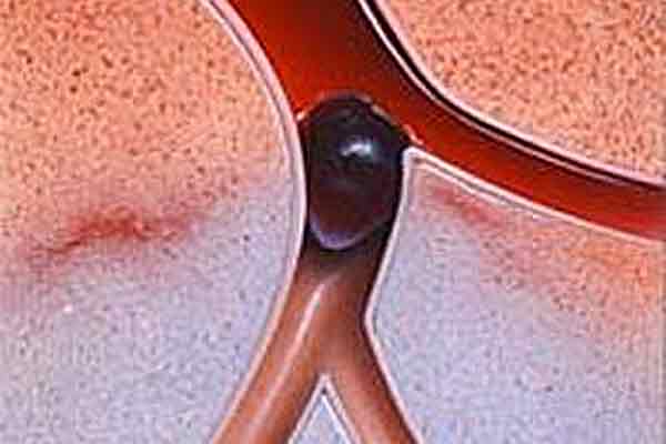 тромбоз лечение