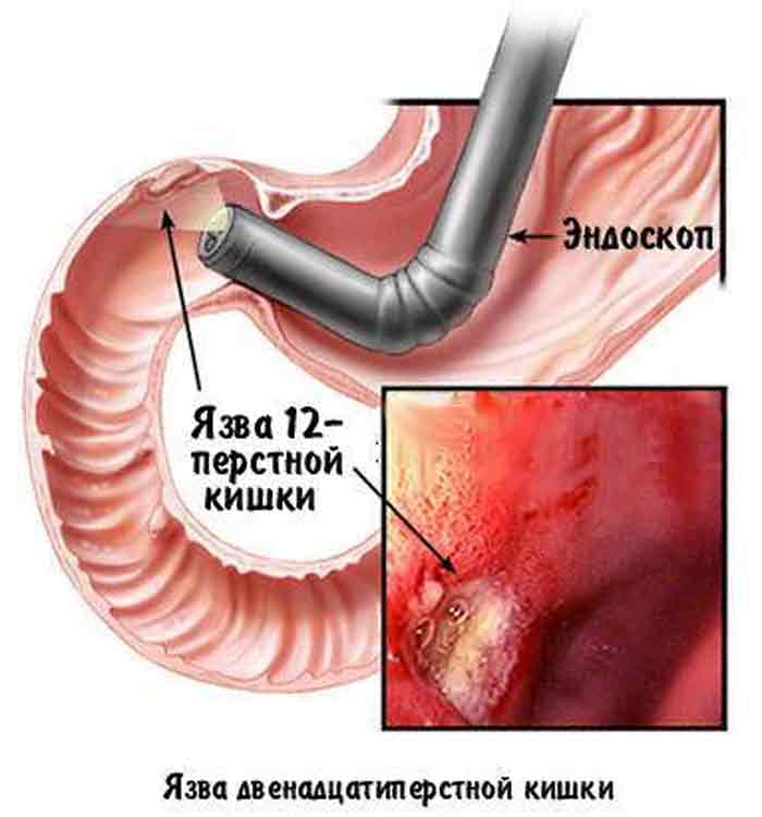 лечение язвы
