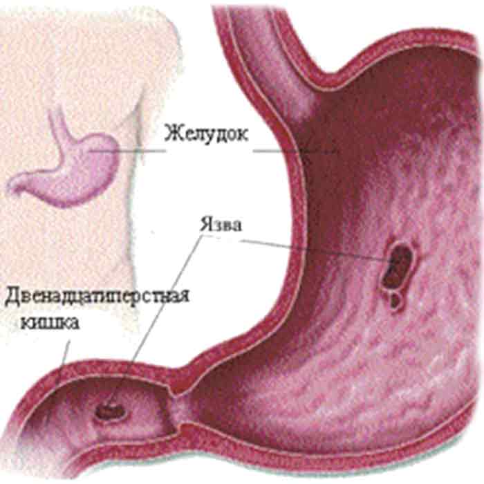 диагностика заболевания 12-перстной кишки