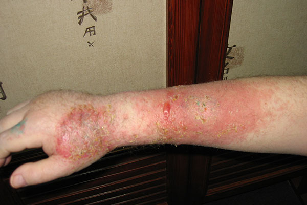 лечение экземы в медцентре