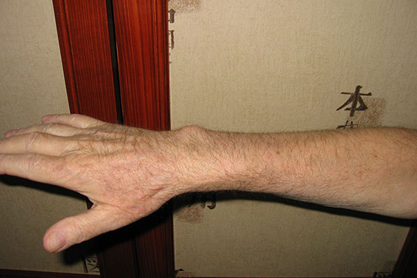 вылечить экзему в Москве 