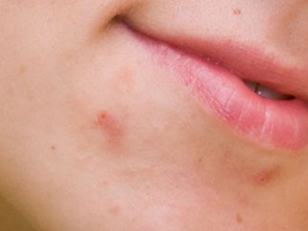 избавиться от прыщей