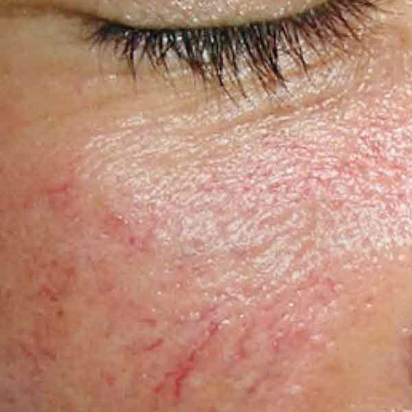 лечить демадекоз кожи