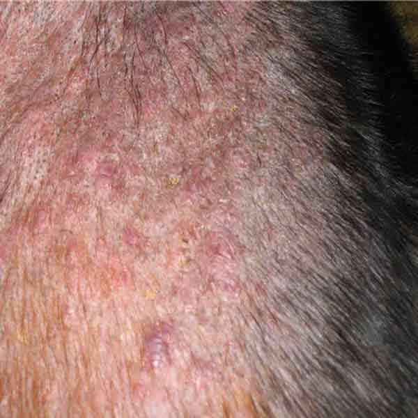 заболевание демадекозом