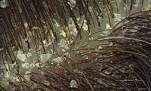 лечиться от перхоти