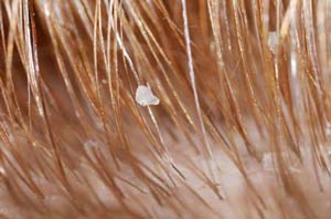 лечить перхоть