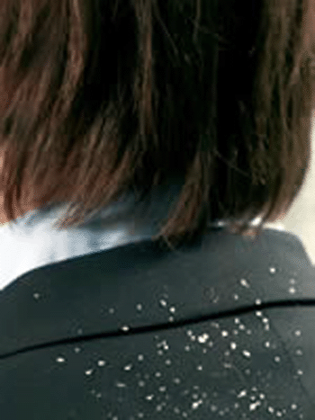 перхоть лечение