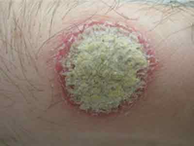 диагностировать и лечить псориаз