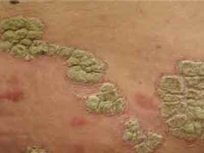 хронический чешуйчатый лишай кожи