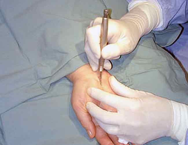 удаление родинок