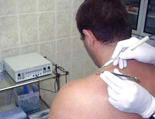 удаление сосудистых звездочек в Москве 