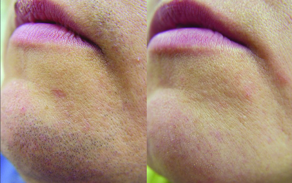 эпиляция у косметолога