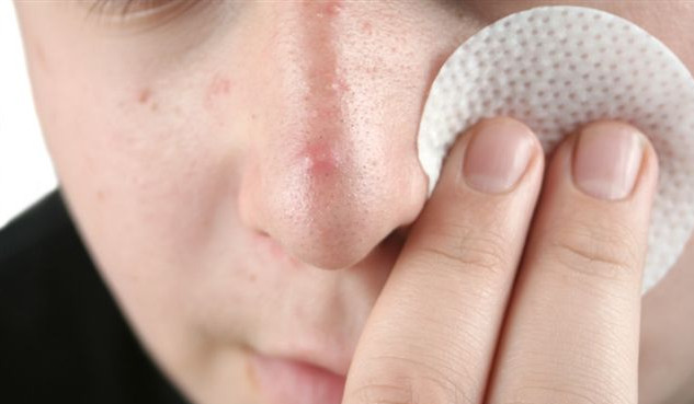 Правила ухода за кожей при акне