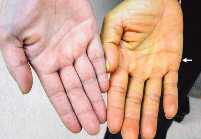 желтуха - симптомы